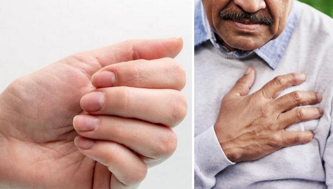 Темні плями під нігтями – ознака підвищеного холестерину чи хвороби серця