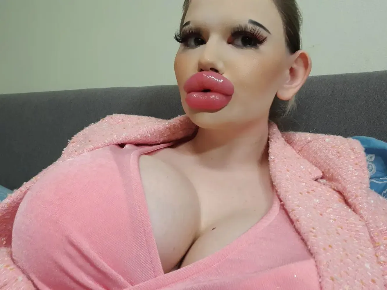 Як виглядає дівчина з найбільшими губами у світі — лікарі кажуть, що вона може через них померти