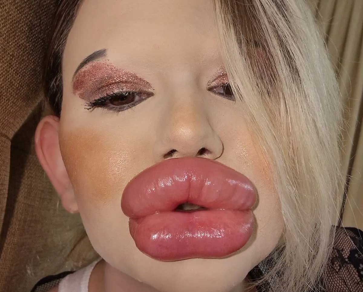 Як виглядає дівчина з найбільшими губами у світі — лікарі кажуть, що вона може через них померти